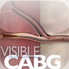 Visible CABG