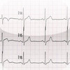 EKG Basics