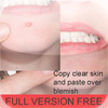 Acne Pimple Remover copy paste