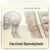 Cervical Spondylosis with Animations