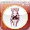 Rheumatoid Arthritis of Knee