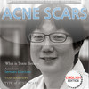 New acne scar treatment - Trans therapy