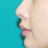 Nasal tip refinement using conchal cartilage grafts